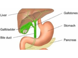Gallbladder Stone Surgery in Delhi
